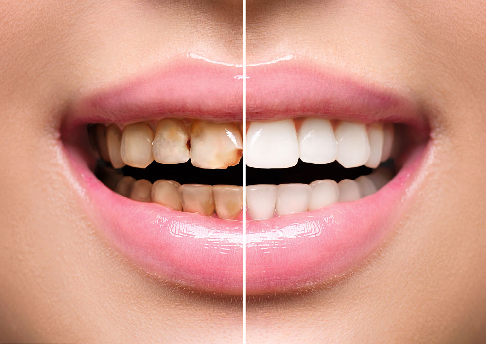 RĂNG SỨ ZIRCONIA: GIẢI PHÁP BỀN CHẮC CHO KHÁCH HÀNG ƯU TIÊN CHỨC NĂNG