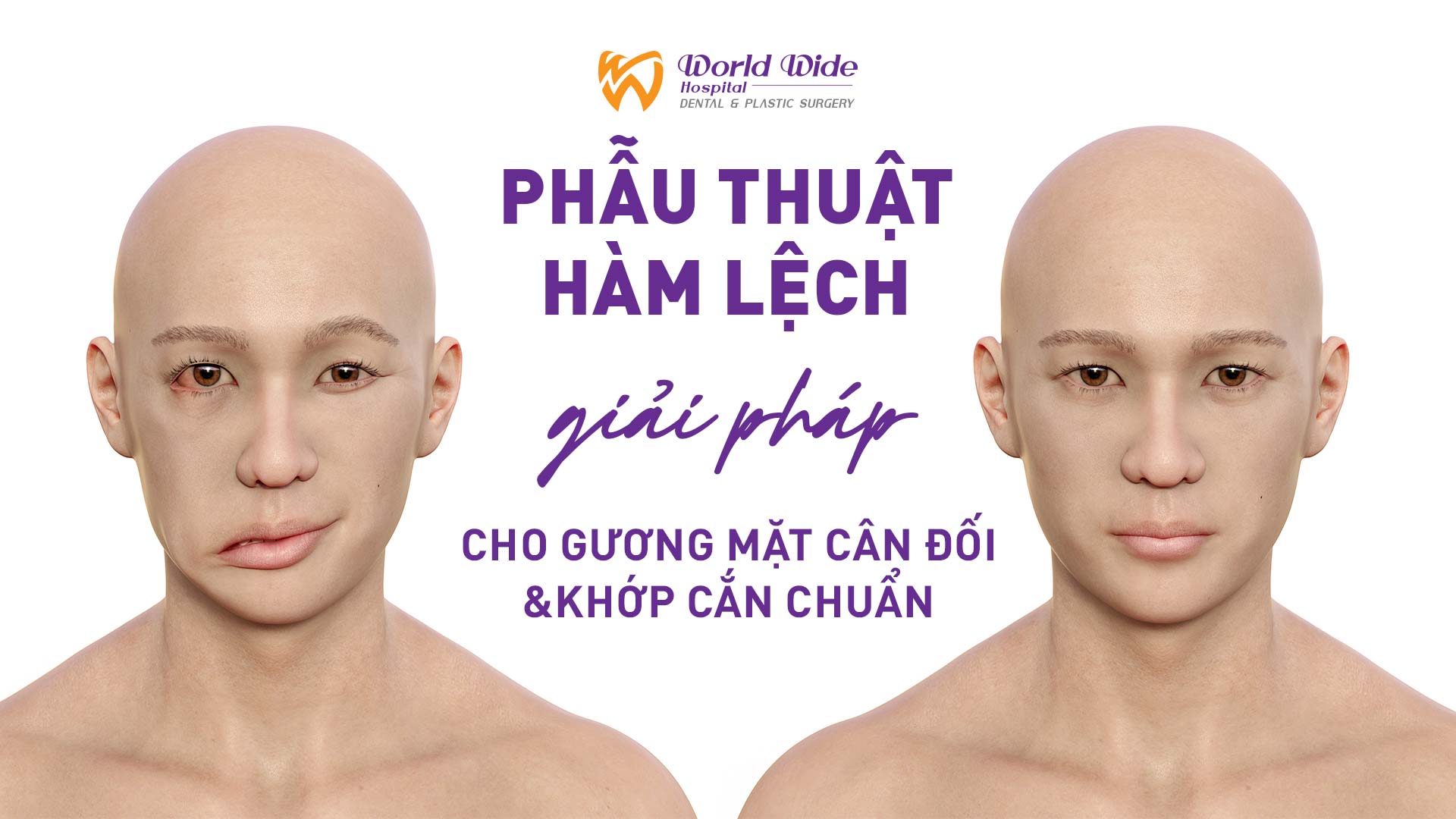 PHẪU THUẬT HÀM LỆCH: GIẢI PHÁP CHO GƯƠNG MẶT CÂN ĐỐI VÀ KHỚP CẮN CHUẨN