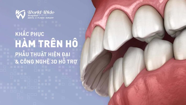 niềng răng tự khoá