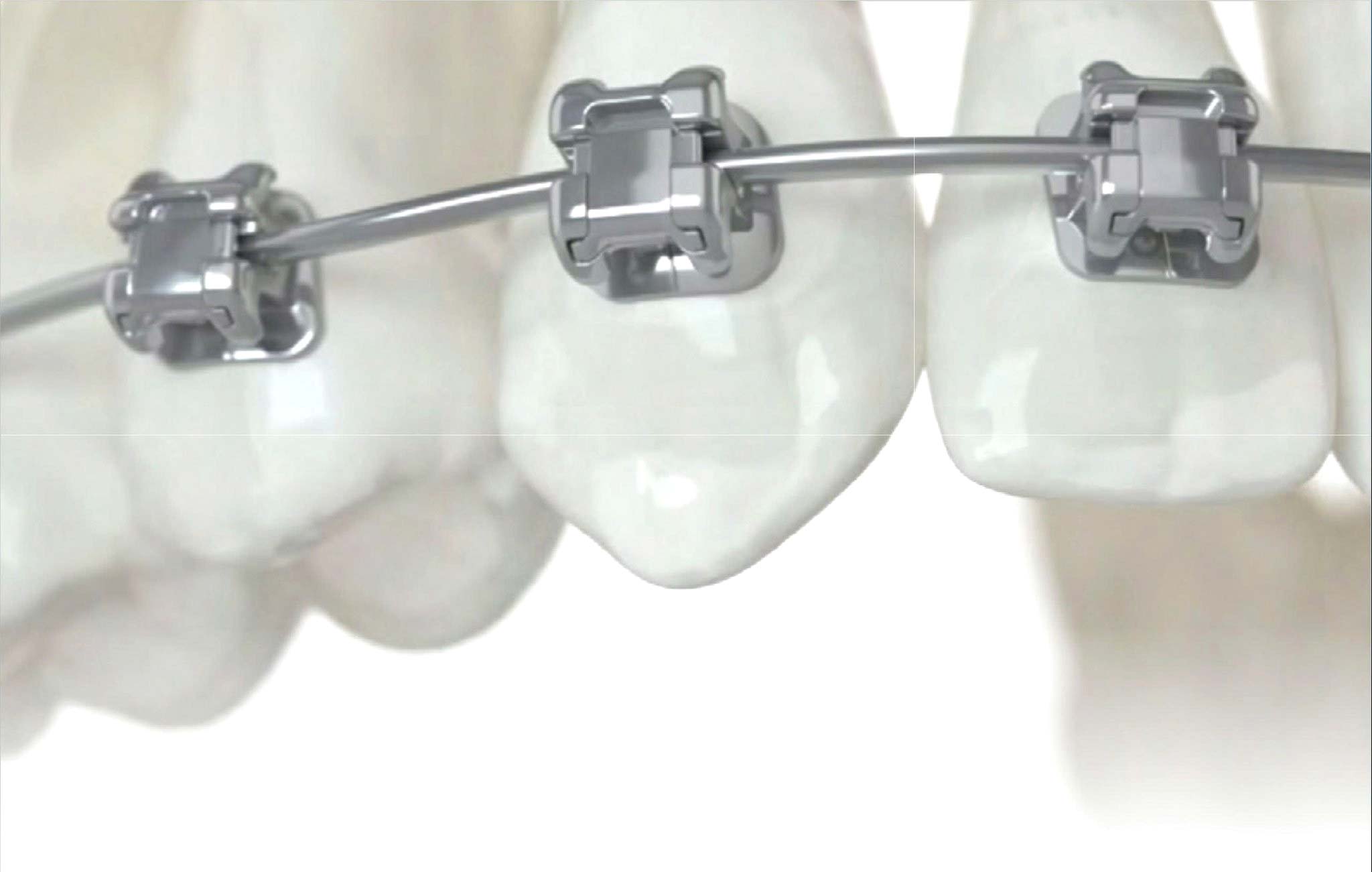 NIỀNG RĂNG TỰ KHÓA CÓ THỰC SỰ NHANH HƠN? PHÂN TÍCH TỪ GÓC NHÌN BÁC SĨ