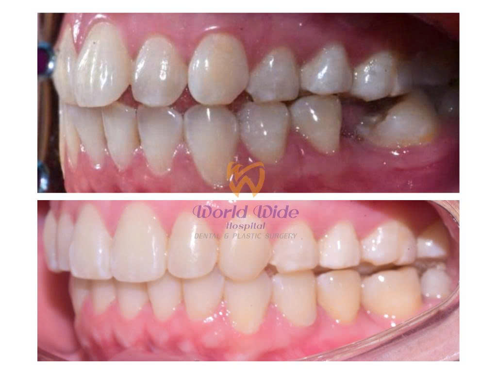 NIỀNG RĂNG CÓ THAY THẾ ĐƯỢC PHẪU THUẬT HÀM KHÔNG?