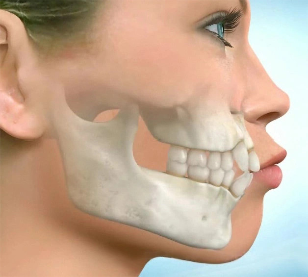Khắc phục hàm trên hô: Phẫu thuật hiện đại và công nghệ 3D hỗ trợ