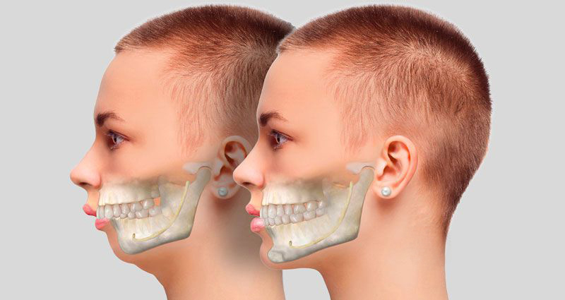 Khắc phục hàm trên hô: Phẫu thuật hiện đại và công nghệ 3D hỗ trợ