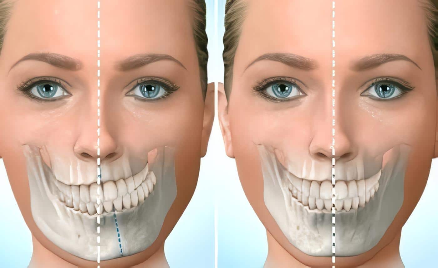 PHẪU THUẬT HÀM LỆCH: GIẢI PHÁP CHO GƯƠNG MẶT CÂN ĐỐI VÀ KHỚP CẮN CHUẨN