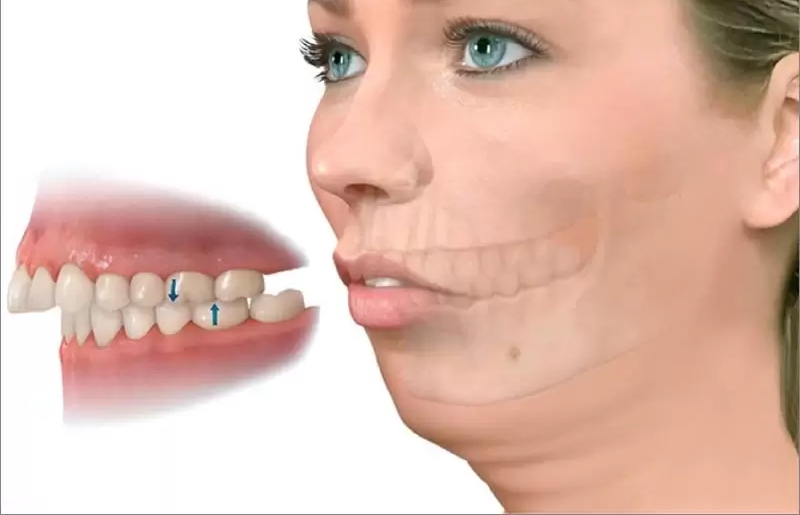 PHẪU THUẬT HÀM LỆCH: GIẢI PHÁP CHO GƯƠNG MẶT CÂN ĐỐI VÀ KHỚP CẮN CHUẨN