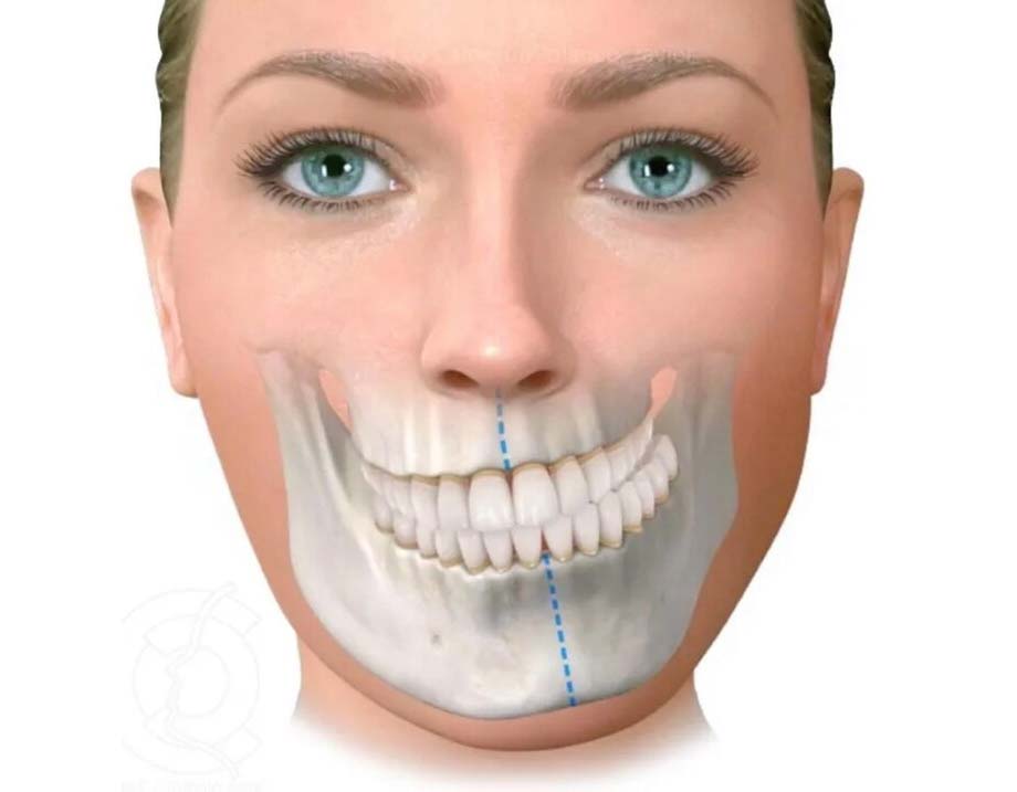 MẶT LỆCH, HÀM LỆCH CÓ PHẪU THUẬT ĐƯỢC KHÔNG?