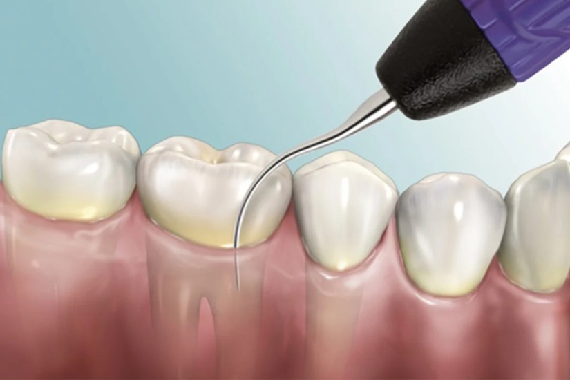 SO SÁNH NHỔ RĂNG KHÔN BẰNG PIEZOTOME VÀ PHƯƠNG PHÁP TRUYỀN THỐNG: ĐÂU LÀ LỰA CHỌN TỐI ƯU?