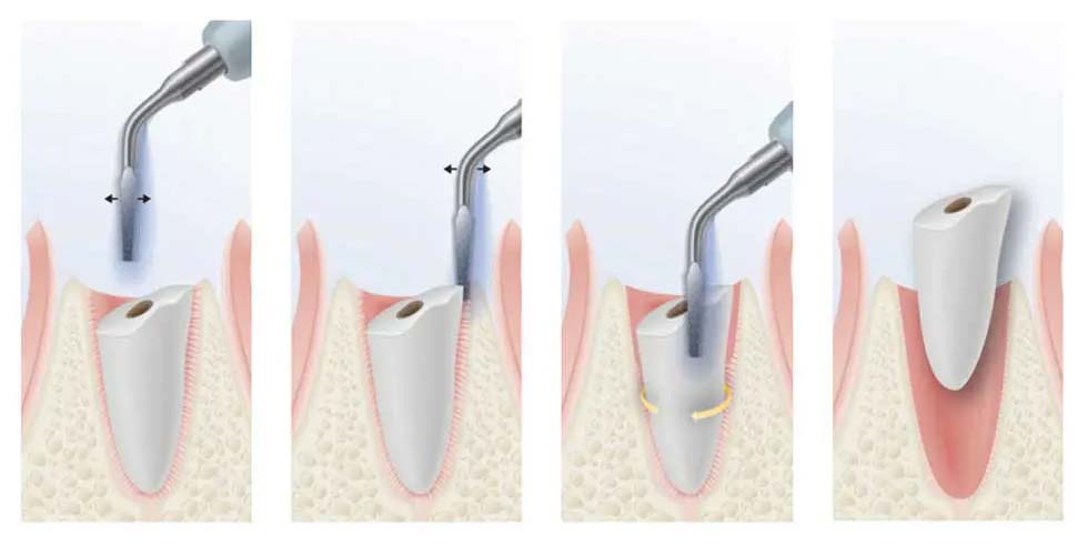 SO SÁNH NHỔ RĂNG KHÔN BẰNG PIEZOTOME VÀ PHƯƠNG PHÁP TRUYỀN THỐNG: ĐÂU LÀ LỰA CHỌN TỐI ƯU?