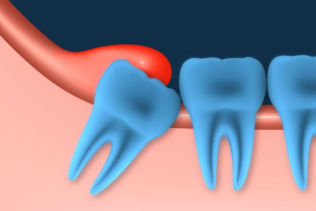 RĂNG KHÔN GẦN DÂY THẦN KINH – CÓ NÊN NHỔ KHÔNG? GIẢI ĐÁP TỪ GÓC NHÌN CHUYÊN MÔN