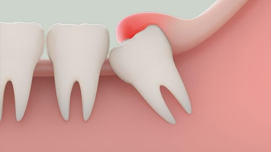 NHỔ RĂNG KHÔN BẰNG MÁY PIEZOTOME – GIẢI PHÁP ÍT ĐAU, ÍT SƯNG TẠI BỆNH VIỆN RHM WORLDWIDE