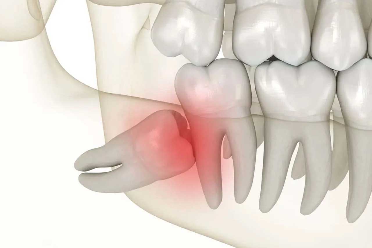 RĂNG KHÔN GẦN DÂY THẦN KINH – CÓ NÊN NHỔ KHÔNG? GIẢI ĐÁP TỪ GÓC NHÌN CHUYÊN MÔN