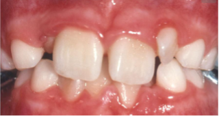 Chỉnh Nha Sớm – Chỉnh Nha Tăng Trưởng: Hành Trình Xây Nụ Cười Khỏe Đẹp Từ Tuổi Thơ chỉnh nha sớm