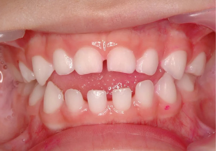 Chỉnh Nha Sớm – Chỉnh Nha Tăng Trưởng: Hành Trình Xây Nụ Cười Khỏe Đẹp Từ Tuổi Thơ
