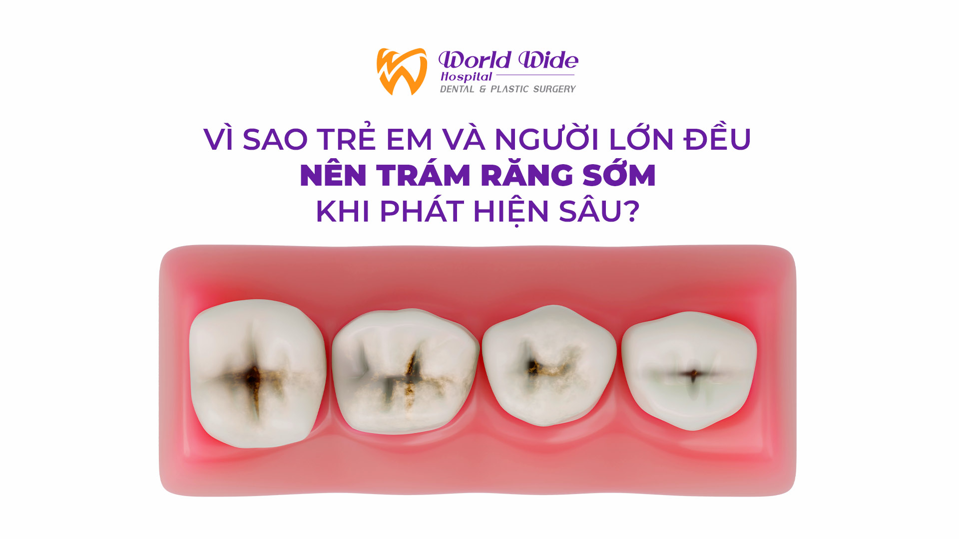 Vì sao trẻ em và người lớn đều nên trám răng sớm khi phát hiện sâu?
