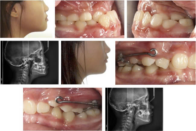 Chỉnh Nha Sớm – Chỉnh Nha Tăng Trưởng: Hành Trình Xây Nụ Cười Khỏe Đẹp Từ Tuổi Thơ