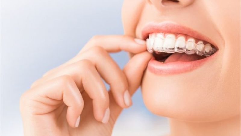 Niềng răng mắc cài và Invisalign: Nên chọn loại nào cho từng độ tuổi?