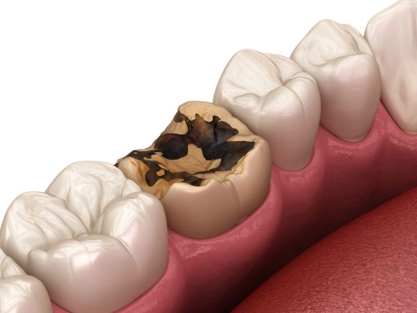 Vì sao trẻ em và người lớn đều nên trám răng sớm khi phát hiện sâu?