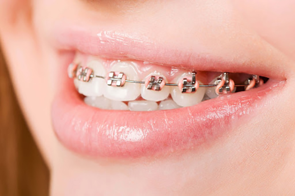 Niềng răng mắc cài và Invisalign: Nên chọn loại nào cho từng độ tuổi?