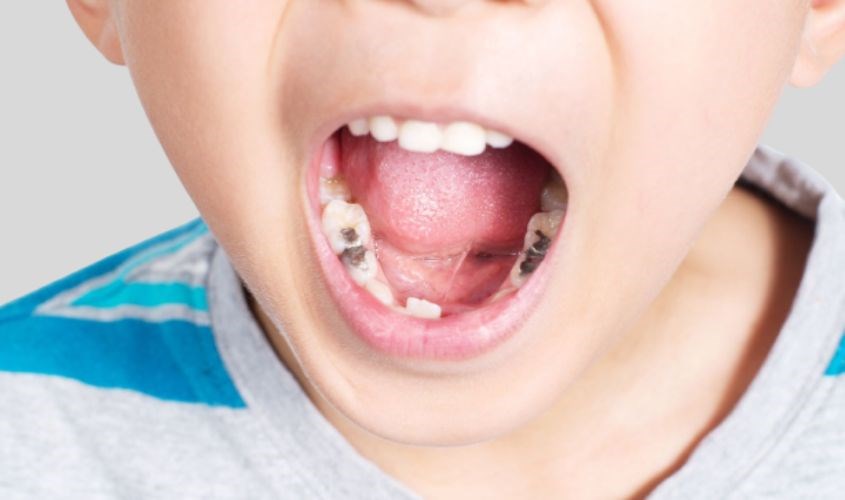 Vì sao trẻ em và người lớn đều nên trám răng sớm khi phát hiện sâu?
