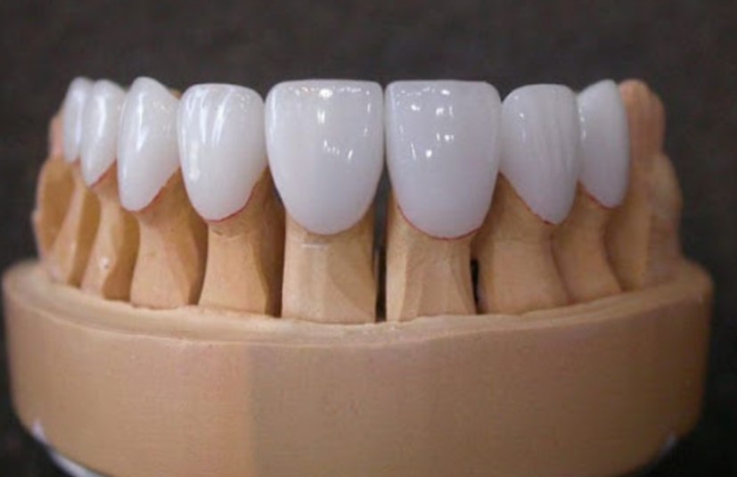 RĂNG SỨ BỀN ĐẸP 10–20 NĂM: CHĂM SÓC SAU BỌC RĂNG SỨ NHƯ THẾ NÀO?