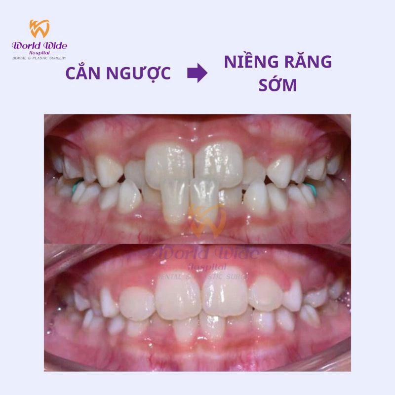 Chỉnh nha sớm tại bệnh viện Worldwide chỉnh nha sớm