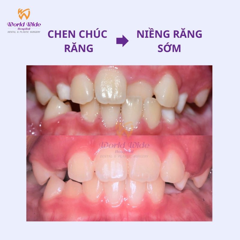 Chỉnh nha sớm tại bệnh viện Worldwide chỉnh nha sớm