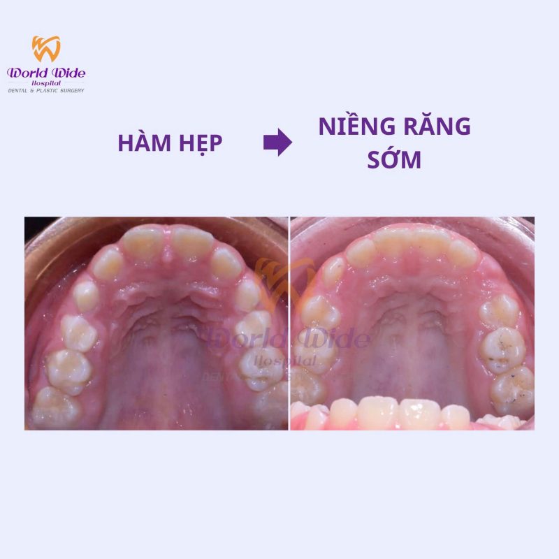 Chỉnh nha sớm tại bệnh viện Worldwide chỉnh nha sớm