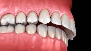 PHẪU THUẬT HÀM HÔ – GIẢI PHÁP TÁI CÂN BẰNG TỈ LỆ GƯƠNG MẶT