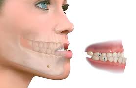 PHẪU THUẬT HÀM HÔ – GIẢI PHÁP TÁI CÂN BẰNG TỈ LỆ GƯƠNG MẶT
