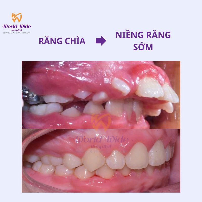 Chỉnh nha sớm tại bệnh viện Worldwide chỉnh nha sớm