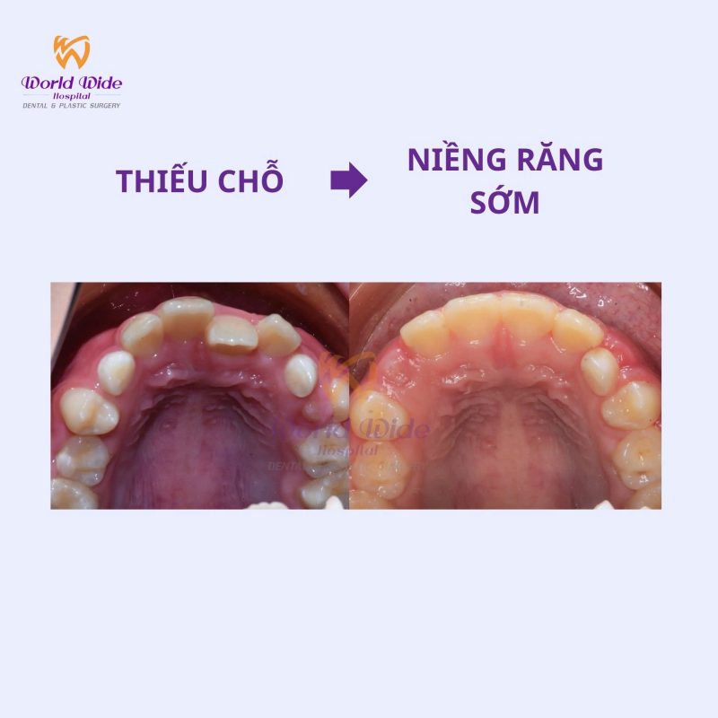 Chỉnh nha sớm tại bệnh viện Worldwide chỉnh nha sớm