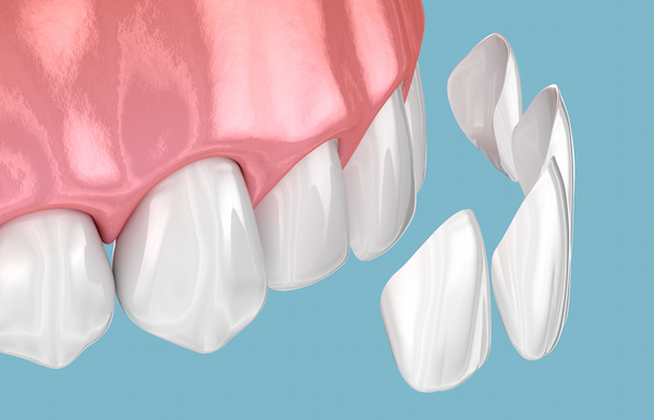 DENTAL CROWNS