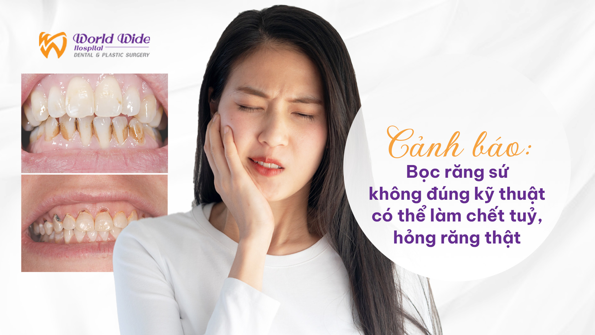 CẢNH BÁO: BỌC RĂNG SỨ KHÔNG ĐÚNG KỸ THUẬT CÓ THỂ LÀM CHẾT TỦY, HỎNG RĂNG THẬT