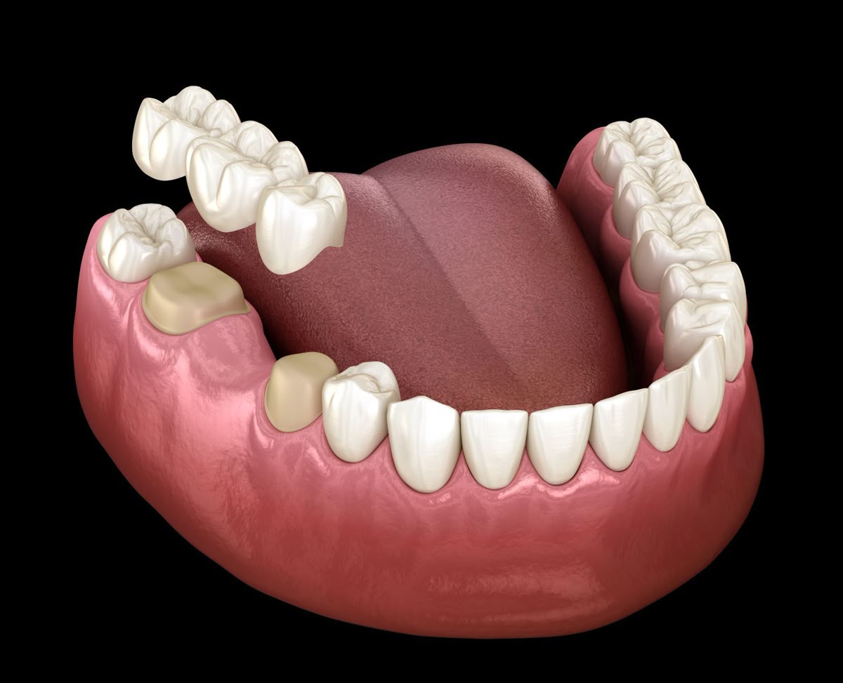 DENTAL CROWNS