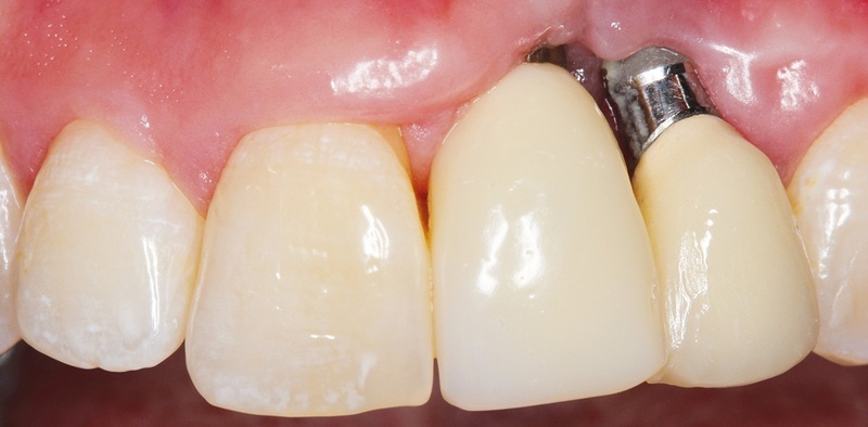 LÀM SAO NHẬN BIẾT IMPLANT BỊ VIÊM HOẶC LỎNG? DẤU HIỆU CẦN KHÁM NGAY