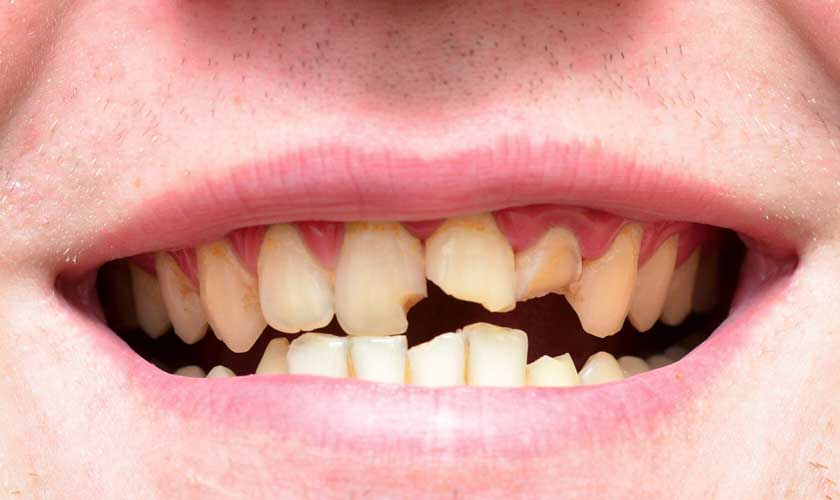 AI NÊN BỌC RĂNG SỨ THẨM MỸ? PHÂN TÍCH TỪ GÓC NHÌN BÁC SĨ PHỤC HÌNH