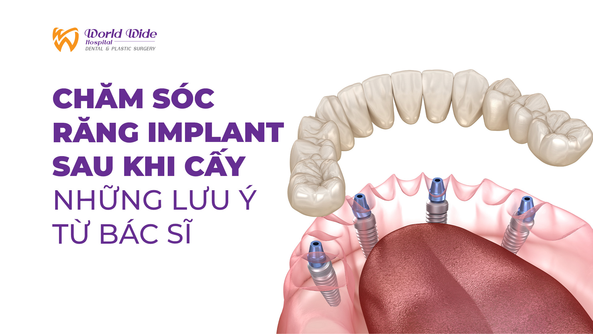 CHĂM SÓC RĂNG IMPLANT SAU KHI CẤY – NHỮNG LƯU Ý TỪ BÁC SĨ