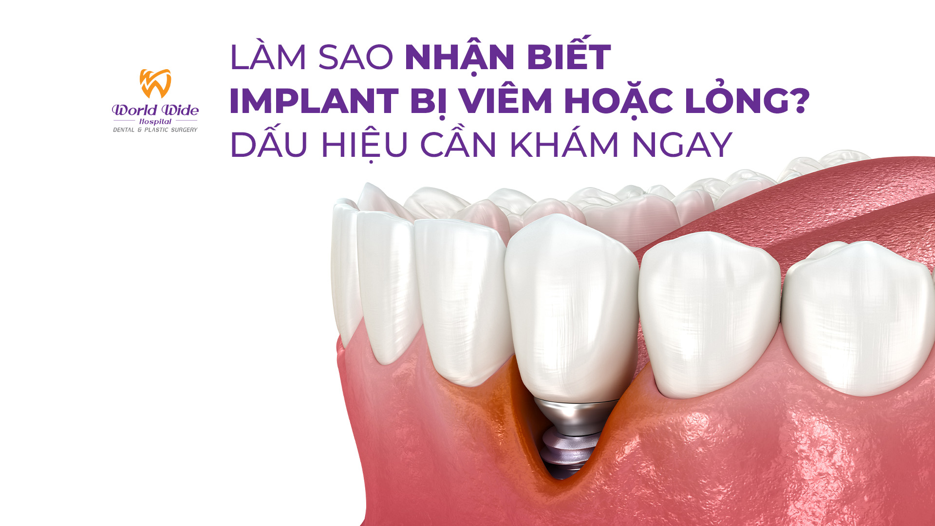 LÀM SAO NHẬN BIẾT IMPLANT BỊ VIÊM HOẶC LỎNG? DẤU HIỆU CẦN KHÁM NGAY