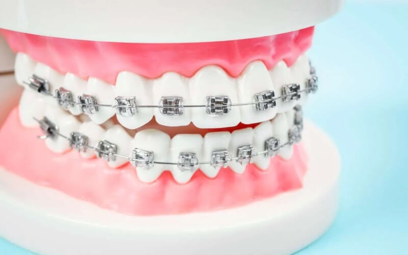 CÓ NÊN NHỔ RĂNG KHI NIỀNG KHÔNG? KHI NÀO BẮT BUỘC PHẢI NHỔ? PHÂN TÍCH TỪ GÓC ĐỘ BÁC SĨ CHỈNH NHA