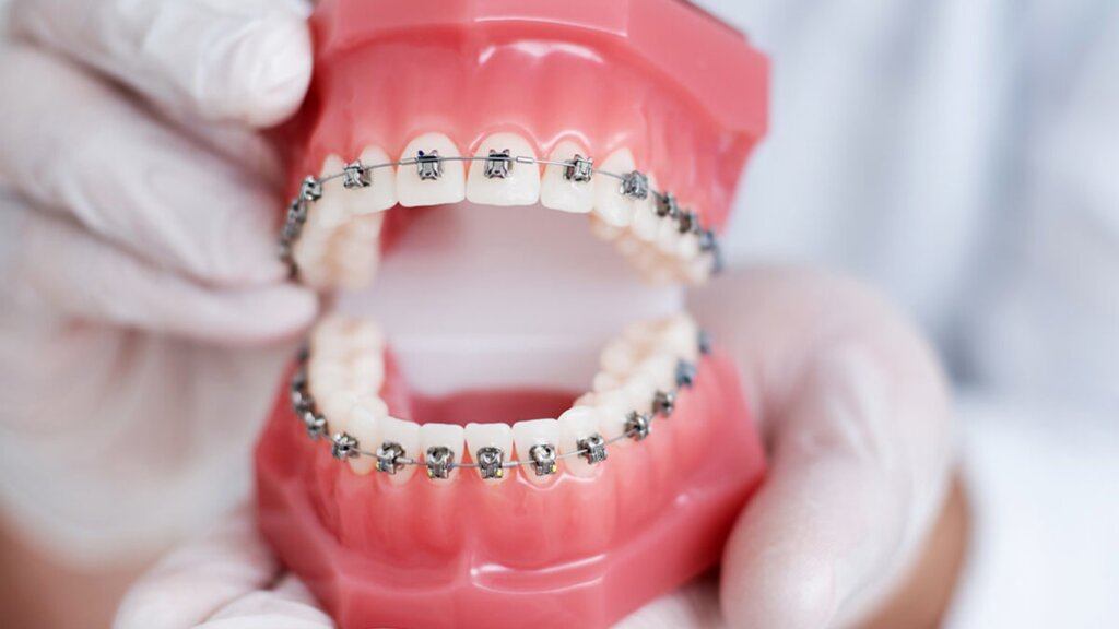 CÓ NÊN NHỔ RĂNG KHI NIỀNG KHÔNG? KHI NÀO BẮT BUỘC PHẢI NHỔ? PHÂN TÍCH TỪ GÓC ĐỘ BÁC SĨ CHỈNH NHA