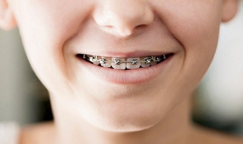 NIỀNG RĂNG CHỈ ĐỂ ĐẸP THÔI HAY CÒN TỐT CHO SỨC KHỎE? PHÂN TÍCH CHUYÊN MÔN DÀNH CHO NGƯỜI TRẺ