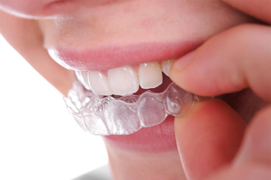 VÌ SAO INVISALIGN ÍT PHẢI TÁI KHÁM HƠN MẮC CÀI? GIẢI THÍCH DƯỚI GÓC ĐỘ CÔNG NGHỆ VÀ BÁC SĨ WORLDWIDE