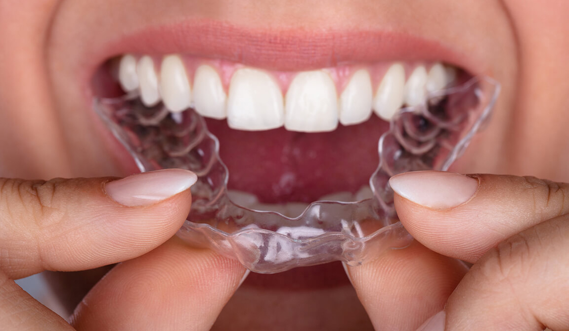 VÌ SAO INVISALIGN ÍT PHẢI TÁI KHÁM HƠN MẮC CÀI? GIẢI THÍCH DƯỚI GÓC ĐỘ CÔNG NGHỆ VÀ BÁC SĨ WORLDWIDE