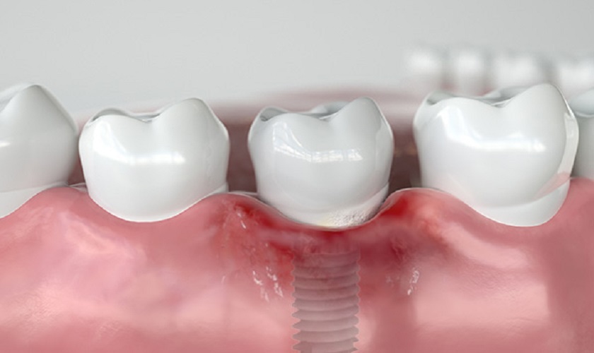 IMPLANT CÓ BỊ ĐÀO THẢI KHÔNG? VÌ SAO CÓ NGƯỜI THẤT BẠI?