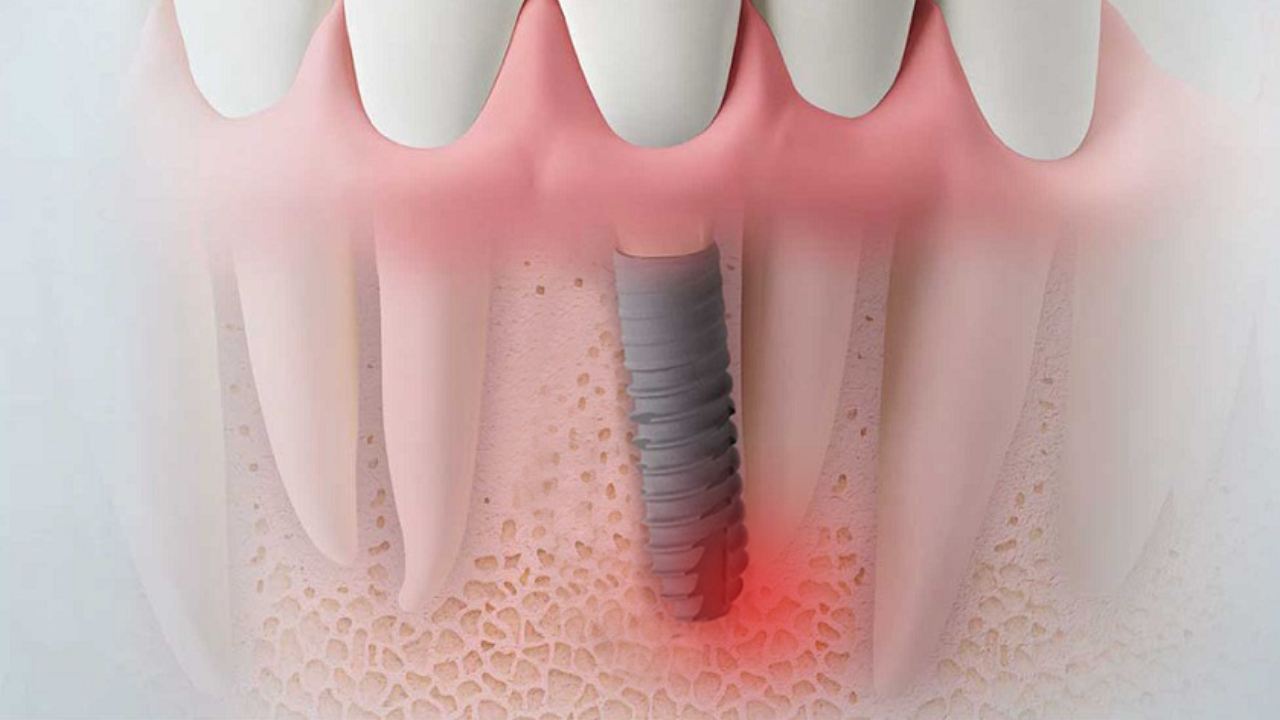 IMPLANT CÓ BỊ ĐÀO THẢI KHÔNG? VÌ SAO CÓ NGƯỜI THẤT BẠI?
