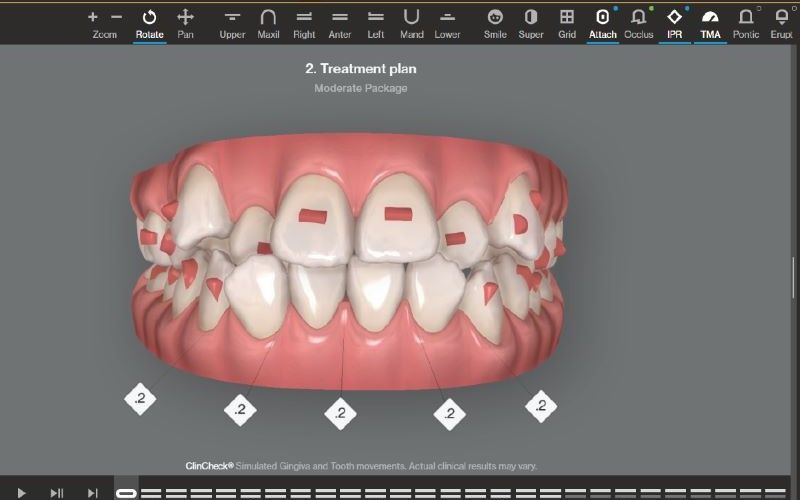 KHÔNG PHẢI KHAY NÀO CŨNG LÀ INVISALIGN – KHÁC BIỆT NẰM Ở CÔNG NGHỆ PHÍA SAU