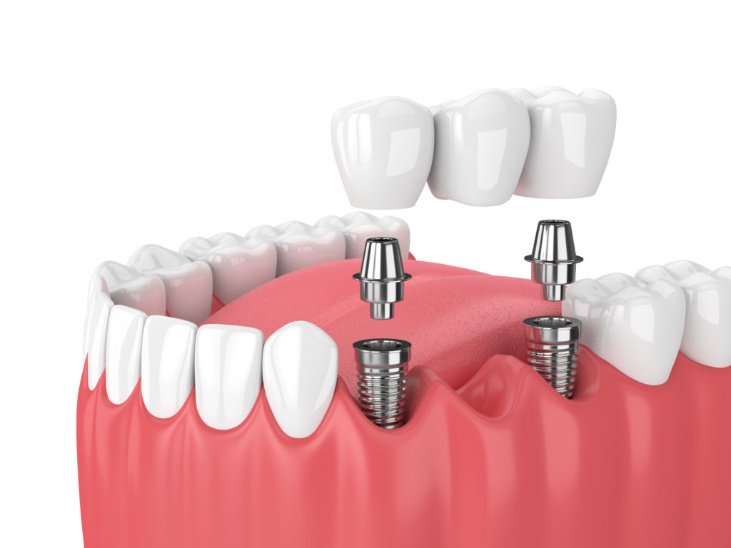 IMPLANT HÀN QUỐC VÀ IMPLANT CHÂU ÂU KHÁC NHAU GÌ? NÊN CHỌN LOẠI NÀO?