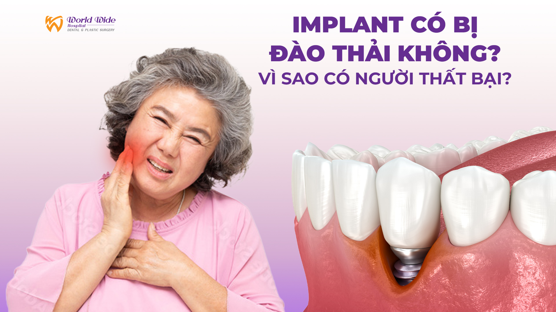 IMPLANT CÓ BỊ ĐÀO THẢI KHÔNG? VÌ SAO CÓ NGƯỜI THẤT BẠI?