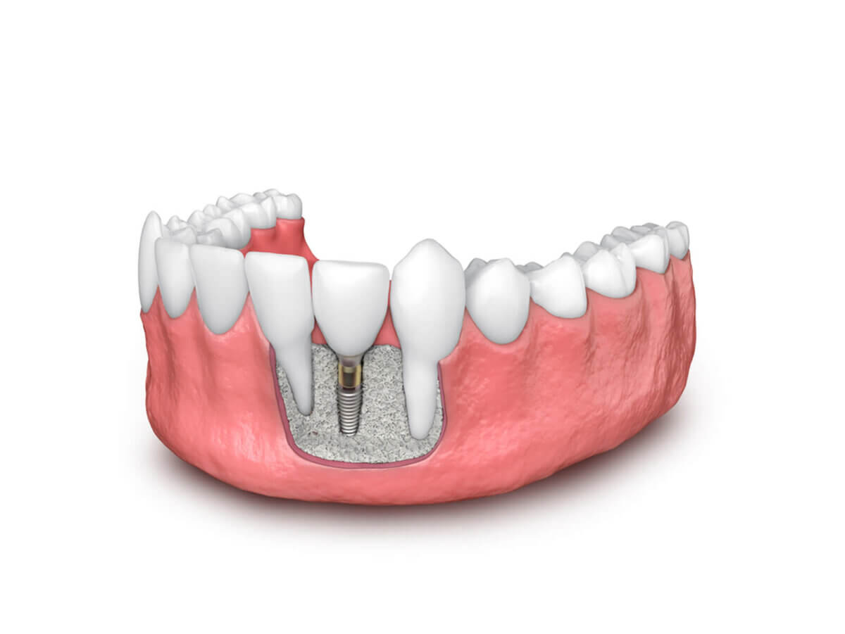 NGƯỜI CAO TUỔI NÊN LÀM HÀM THÁO LẮP HAY IMPLANT?