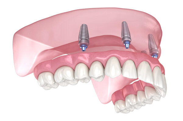 IMPLANT CÓ BỊ ĐÀO THẢI KHÔNG? VÌ SAO CÓ NGƯỜI THẤT BẠI?